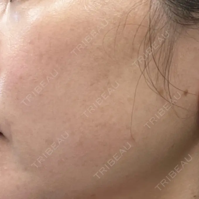 ルメッカ ルラ美容クリニック 広島院 DAY 8 メイン用