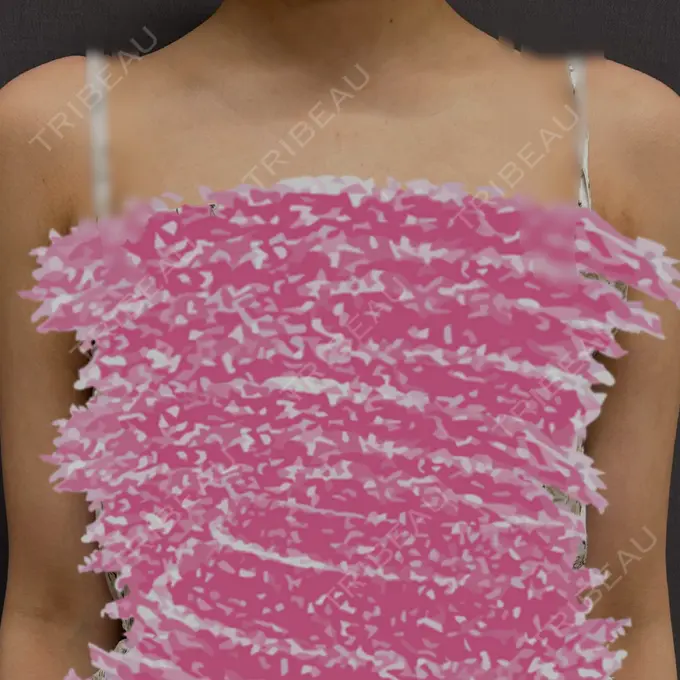 脂肪吸引（二の腕） / 脂肪吸引（肩） / その他（ボディ） ルーチェクリニック 銀座院 AFTER メイン用