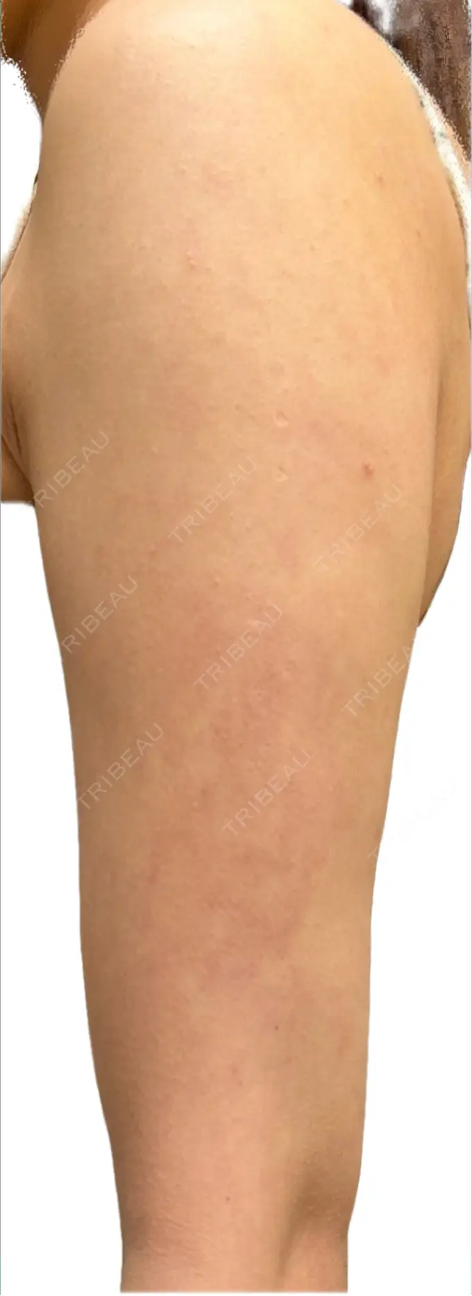 脂肪吸引（二の腕） / 脂肪吸引（肩） / その他（ボディ） ルーチェクリニック 銀座院 DAY 100 メイン用