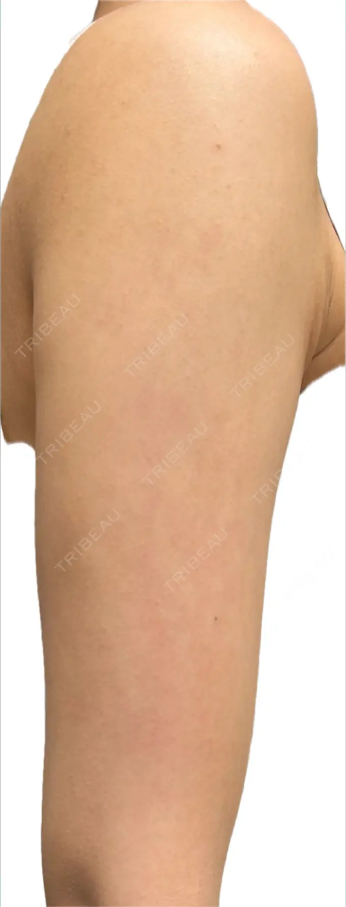 脂肪吸引（二の腕） / 脂肪吸引（肩） / その他（ボディ） ルーチェクリニック 銀座院 DAY 100 メイン用