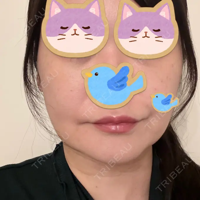 糸リフト / クマ治療 / 脂肪吸引（顔） / 脂肪注入（目の下） / ヒアルロン酸注入（涙袋） / ヒアルロン酸注入（唇） 東京シンデレラ美容外科 池袋院 DAY 6 メイン用