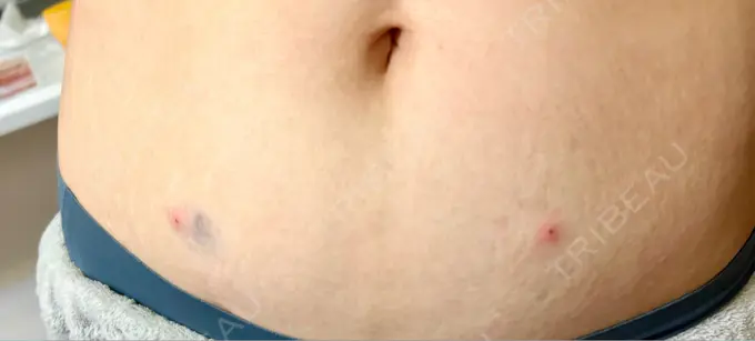 脂肪溶解注射（お腹） ルラ美容クリニック 神戸院 AFTER メイン用
