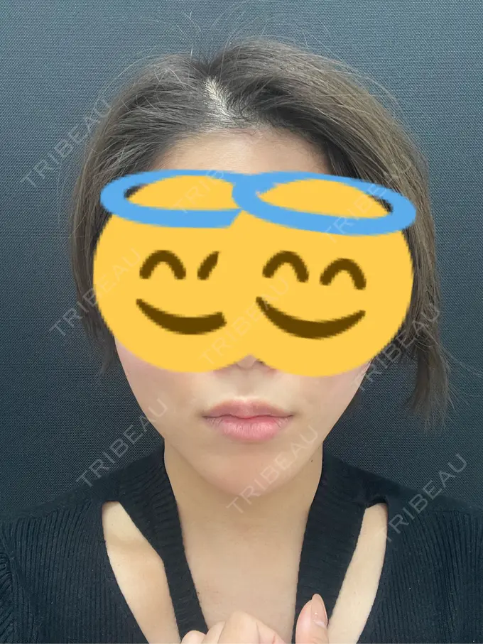 糸リフト 東京シンデレラ美容外科 池袋院 DAY 0 メイン用