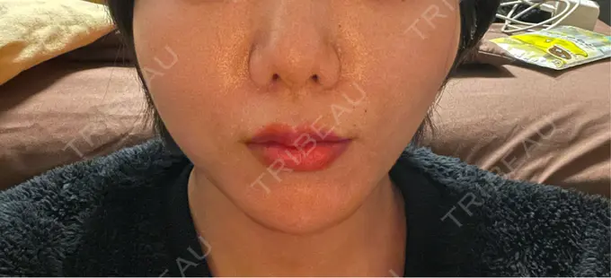 糸リフト 東京シンデレラ美容外科 池袋院 DAY 5 メイン用