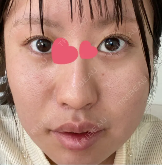 眼瞼下垂（非切開） / ピアス穴あけ / ニキビ治療 しむら皮膚科クリニック DAY 15 メイン用