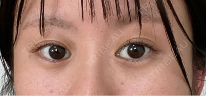 眼瞼下垂（非切開） / ピアス穴あけ / ニキビ治療 しむら皮膚科クリニック DAY 15 メイン用