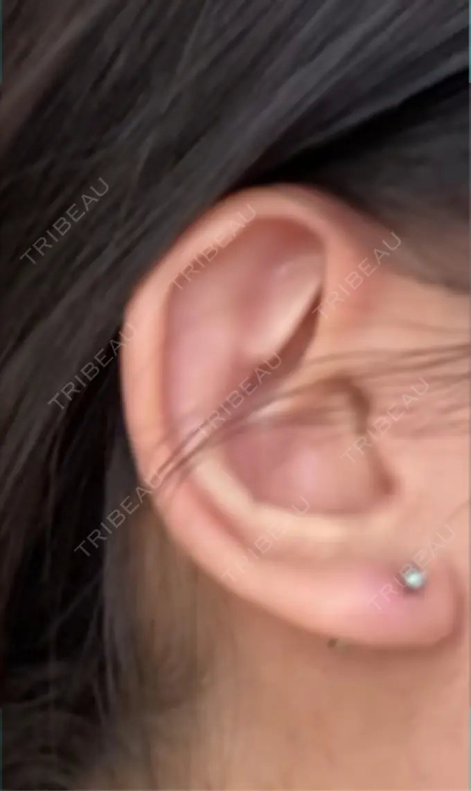 眼瞼下垂（非切開） / ピアス穴あけ / ニキビ治療 しむら皮膚科クリニック DAY 15 メイン用