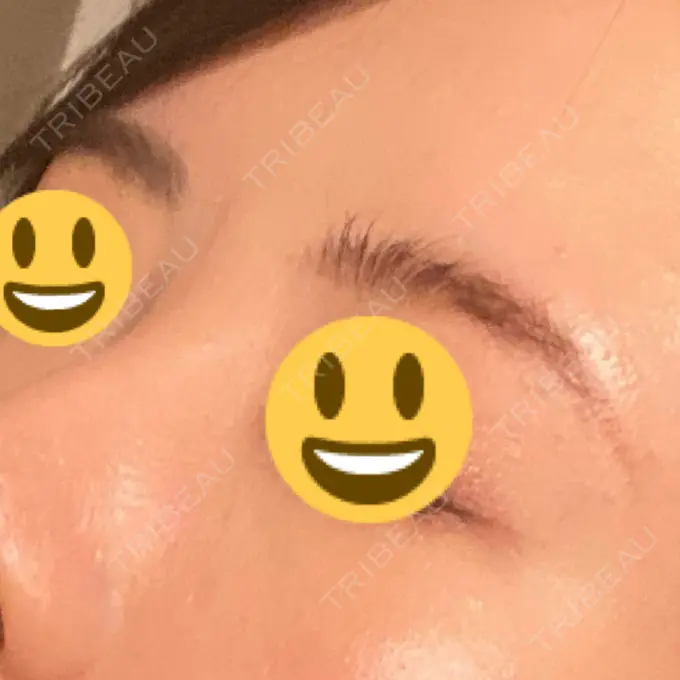 ボトックス（眉間） TCB東京中央美容外科 千葉駅前院 AFTER メイン用