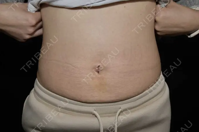 へそ形成 藤・ナチュレ美容クリニック 銀座院 AFTER メイン用