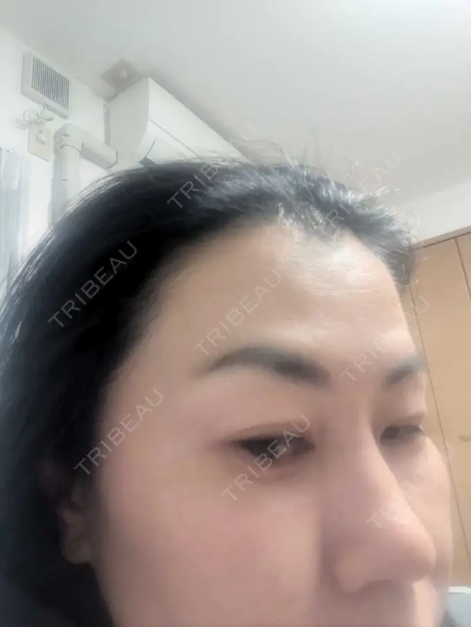 ボトックス（あご） / ボトックス（眉間） / ボトックス（額） TCB東京中央美容外科 松山院 DAY 1 メイン用