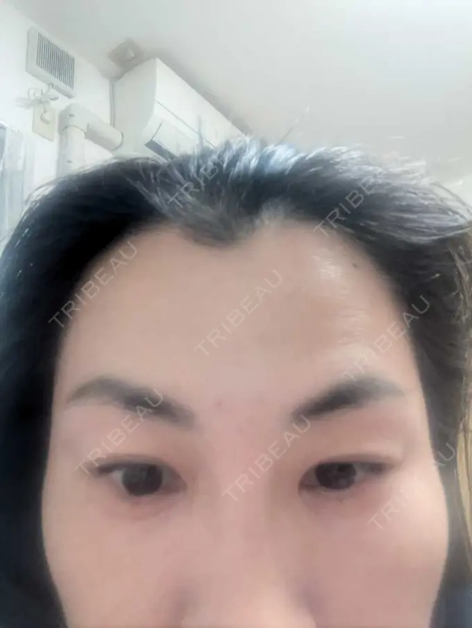 ボトックス（あご） / ボトックス（眉間） / ボトックス（額） TCB東京中央美容外科 松山院 AFTER メイン用