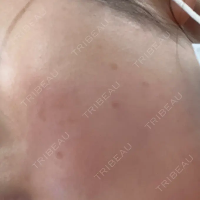 ピーリング（ニキビ・毛穴） / ルメッカ ルラ美容クリニック 神戸院 AFTER メイン用