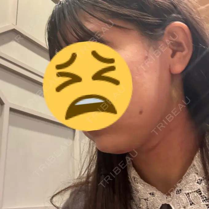 糸リフト / バッカルファット除去 / 脂肪吸引（顔） / メーラーファット除去 / ジョールファット除去 RIVER CLINIC（リバークリニック） DAY 1 メイン用