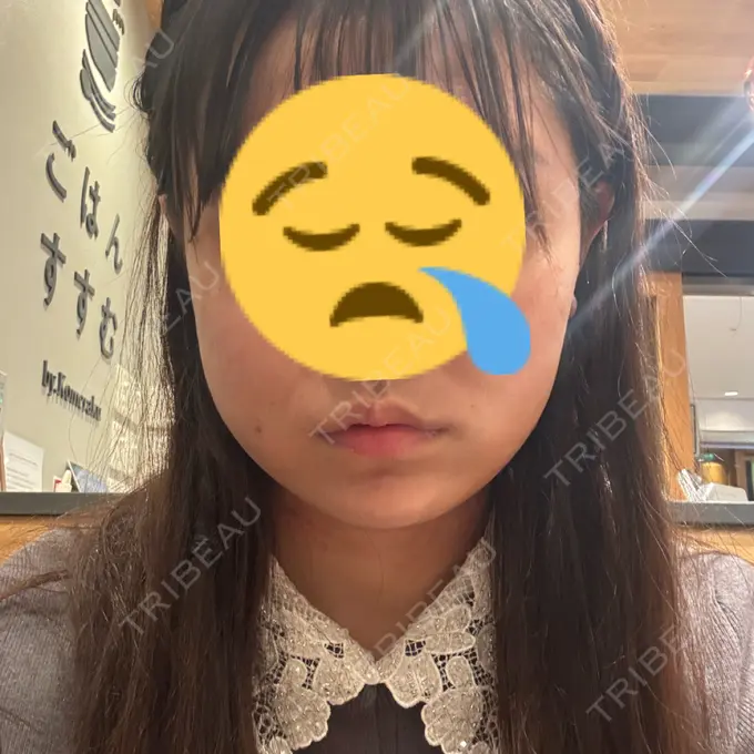 糸リフト / バッカルファット除去 / 脂肪吸引（顔） / メーラーファット除去 / ジョールファット除去 RIVER CLINIC（リバークリニック） DAY 1 メイン用