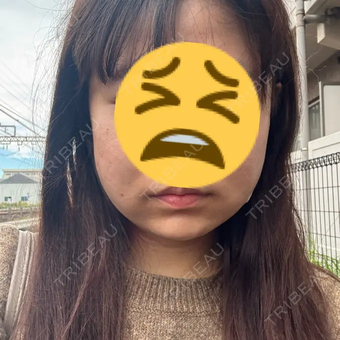 糸リフト / バッカルファット除去 / 脂肪吸引（顔） / メーラーファット除去 / ジョールファット除去 RIVER CLINIC（リバークリニック） DAY 2 メイン用