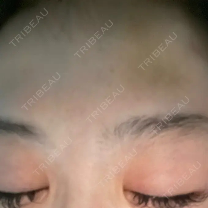 ボトックス（眉間） / ボトックス（額） TCB東京中央美容外科 神戸院 DAY 3 メイン用