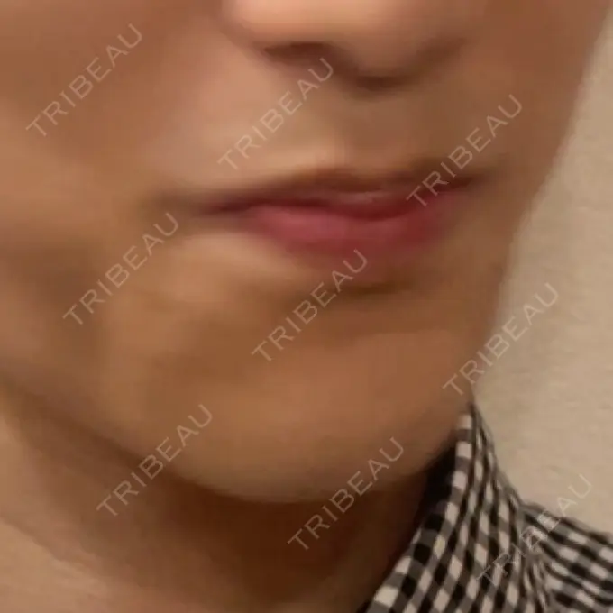 ボトックス（口角） / ボトックス（目尻） / ボトックス（人中） 春山記念病院 AFTER メイン用