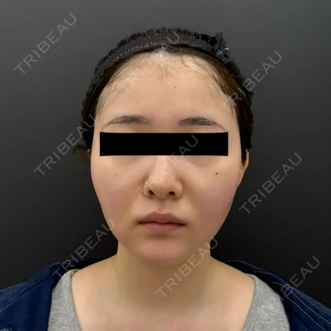 糸リフト / バッカルファット除去 / 脂肪吸引（顔） BLINC CLINIC （ブリンク クリニック） DAY 10 メイン用