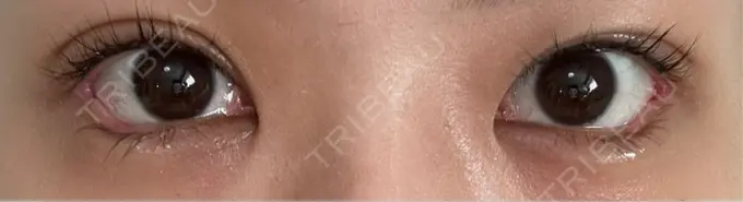 目尻切開 / タレ目形成・グラマラスライン（埋没） LOUIS CLINIC 二子玉川院【ルイクリニック】 DAY 7 メイン用