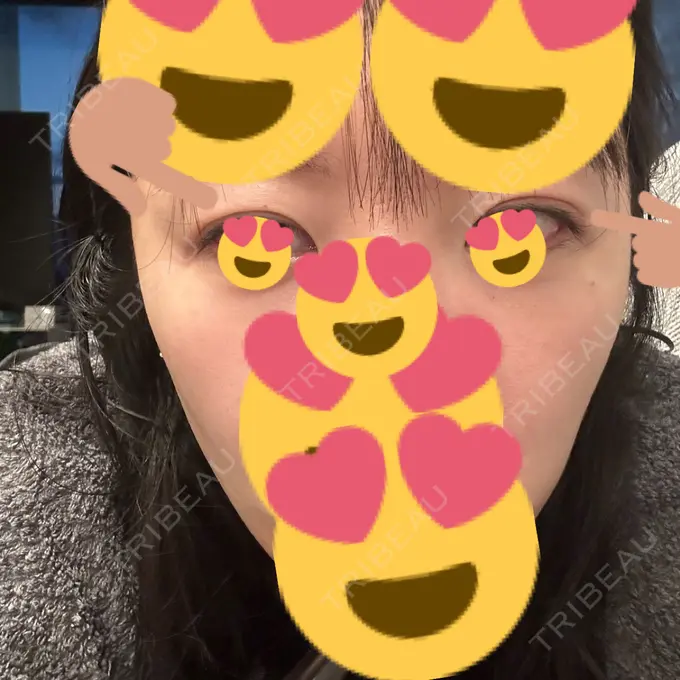 糸リフト / 脂肪吸引（顔） / 脂肪吸引（二の腕） / 上まぶたたるみ取り / 上まぶたの脂肪取り / ジョールファット除去 / 脂肪吸引（肩） / ボトックス（エラ・小顔） 湘南美容クリニック 秋葉原院 DAY 167 メイン用