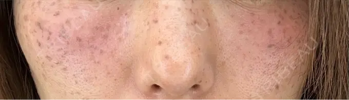 イオン導入 / ルメッカ ルラ美容クリニック 札幌本院 DAY 0 メイン用