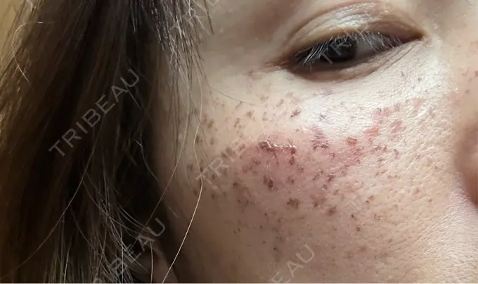 イオン導入 / ルメッカ ルラ美容クリニック 札幌本院 DAY 0 メイン用