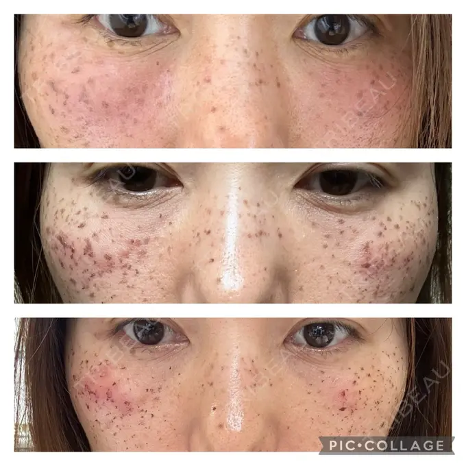 イオン導入 / ルメッカ ルラ美容クリニック 札幌本院 DAY 0 メイン用