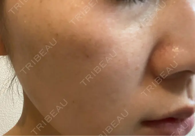 ルメッカ ルラ美容クリニック 横浜院 DAY 5 メイン用