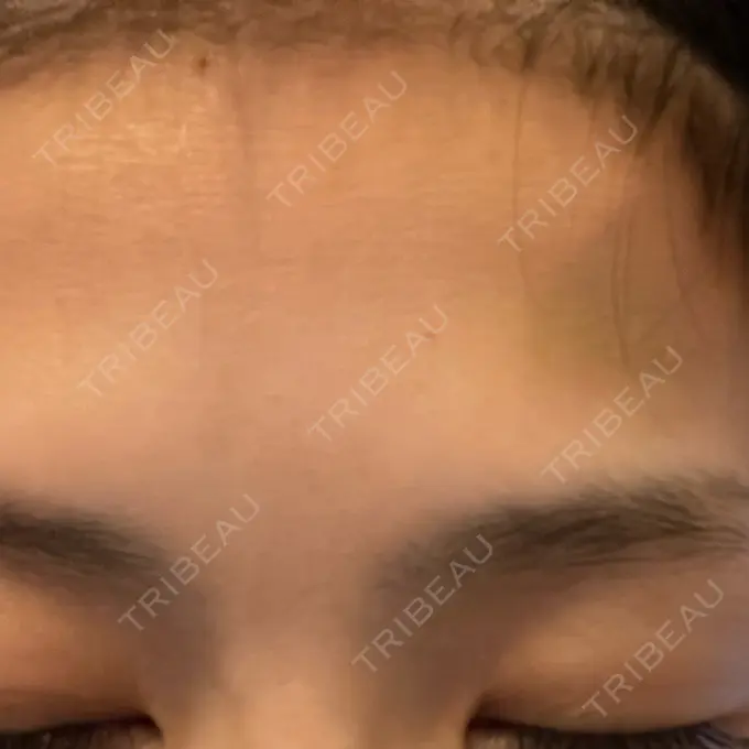 ボトックス（眉間） / ボトックス（額） TCB東京中央美容外科 神戸院 DAY 5 メイン用