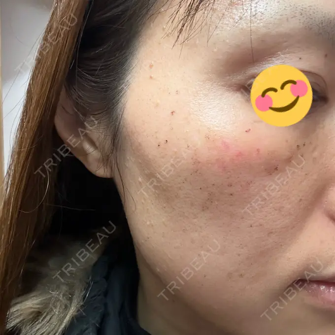 イオン導入 / ルメッカ ルラ美容クリニック 札幌本院 AFTER メイン用