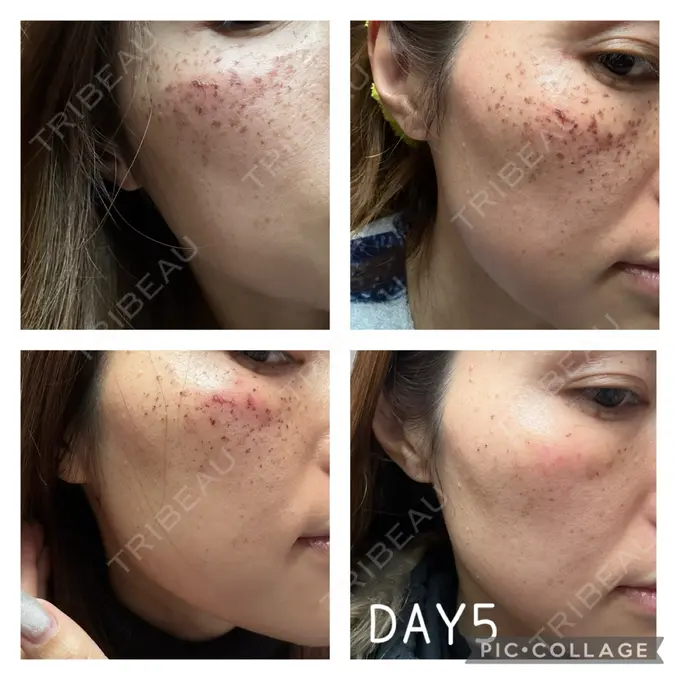 イオン導入 / ルメッカ ルラ美容クリニック 札幌本院 DAY 4 メイン用