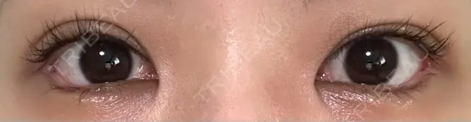 目尻切開 / タレ目形成・グラマラスライン（埋没） LOUIS CLINIC 二子玉川院【ルイクリニック】 DAY 9 メイン用