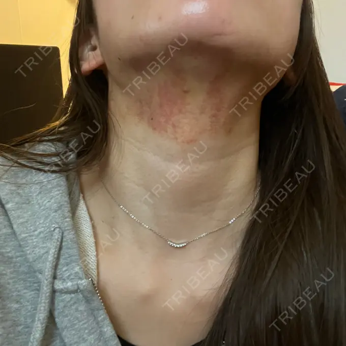 その他（肌） / RF（高周波）たるみ治療 BISIN GINZA CLINIC DAY 2 メイン用