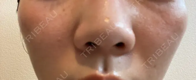 ルメッカ ルラ美容クリニック 横浜院 DAY 5 メイン用