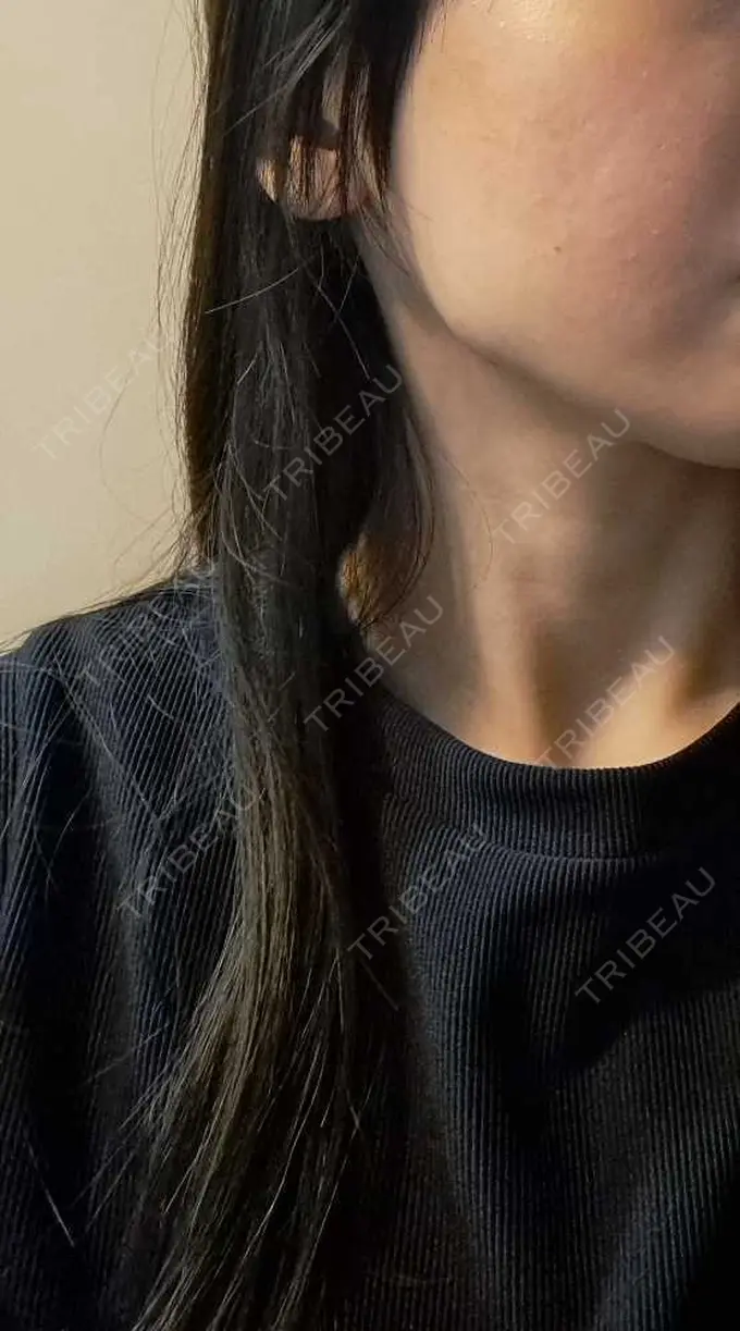 ボトックス（エラ・小顔） TCB東京中央美容外科 柏院 DAY 1 メイン用