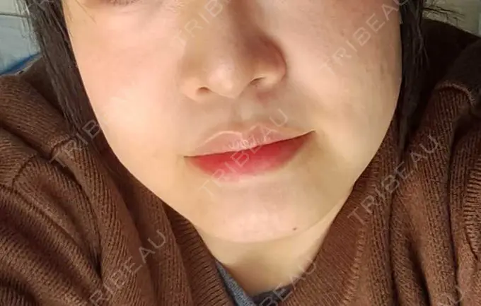 ボトックス（エラ・小顔） TCB東京中央美容外科 柏院 DAY 2 メイン用