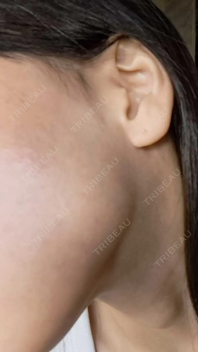 ボトックス（エラ・小顔） TCB東京中央美容外科 柏院 DAY 0 メイン用