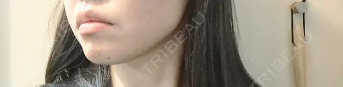 ボトックス（エラ・小顔） TCB東京中央美容外科 柏院 DAY 0 メイン用