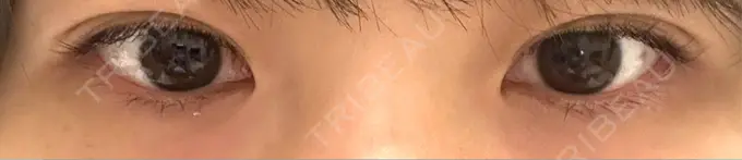 二重埋没 / 自然癒着法 Brandnew Beauty Clinic DAY 1 メイン用