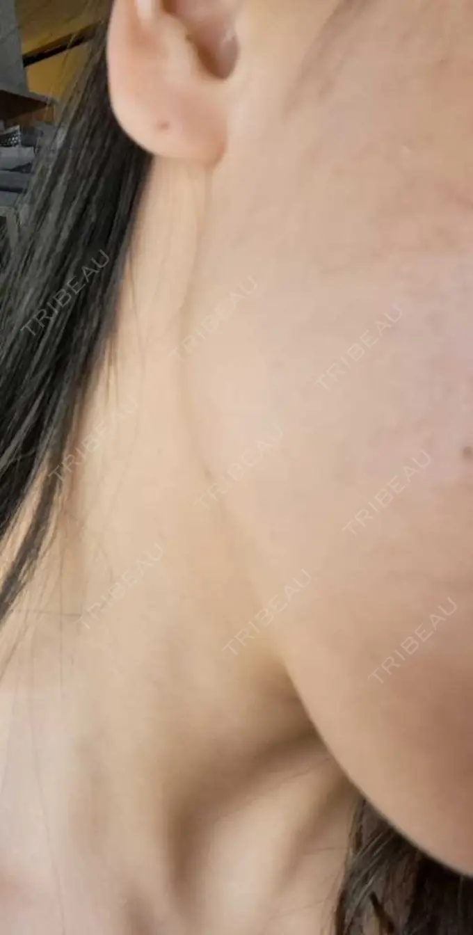 ボトックス（エラ・小顔） TCB東京中央美容外科 柏院 DAY 4 メイン用