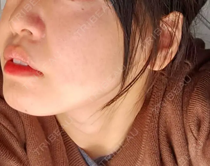 ボトックス（エラ・小顔） TCB東京中央美容外科 柏院 AFTER メイン用