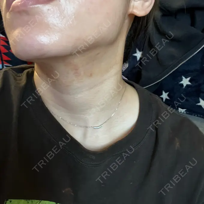 その他（肌） / RF（高周波）たるみ治療 BISIN GINZA CLINIC DAY 3 メイン用