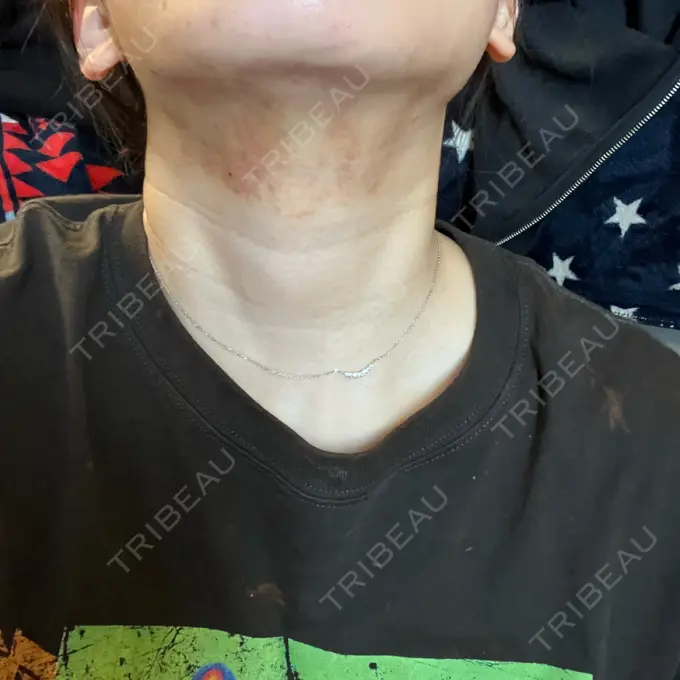 その他（肌） / RF（高周波）たるみ治療 BISIN GINZA CLINIC DAY 3 メイン用