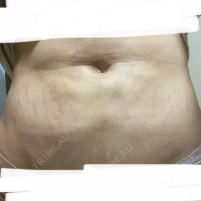 脂肪吸引（顔） / 脂肪吸引（二の腕） / 医療痩身（お腹） / 脂肪吸引（腰） / 脂肪吸引（肩） Mods Clinic（モッズクリニック） 福岡院 DAY 15 メイン用