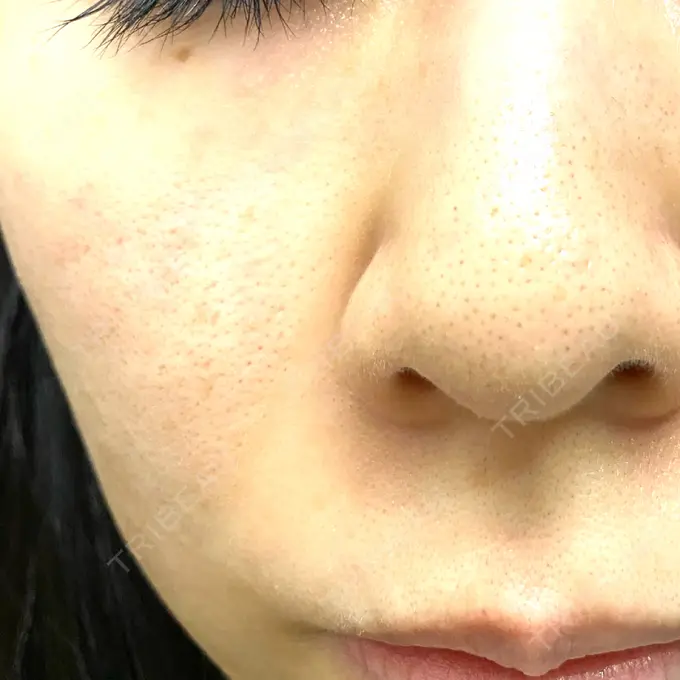 医療脱毛（顔） NI MEDICAL CLINIC AFTER メイン用