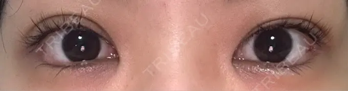 目尻切開 / タレ目形成・グラマラスライン（埋没） LOUIS CLINIC 二子玉川院【ルイクリニック】 DAY 11 メイン用