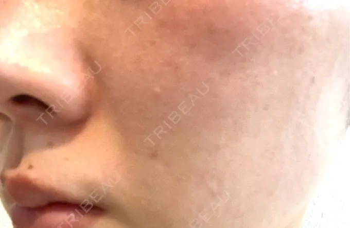 ルメッカ ルラ美容クリニック 横浜院 DAY 7 メイン用