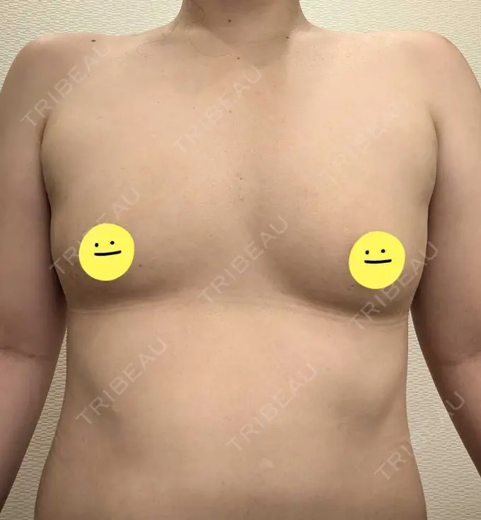 脂肪吸引（脚） / 脂肪吸引（お尻） / 豊胸（脂肪注入） Mods Clinic（モッズクリニック） 名古屋院 DAY 89 メイン用