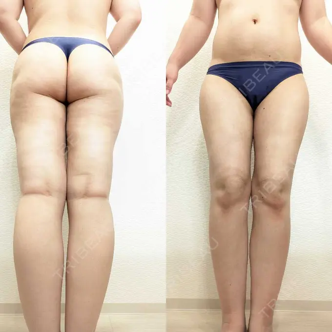 脂肪吸引（脚） / 脂肪吸引（お尻） / 豊胸（脂肪注入） Mods Clinic（モッズクリニック） 名古屋院 DAY 89 メイン用