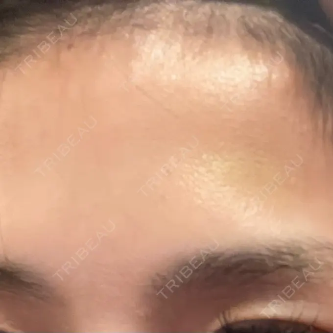 ボトックス（眉間） / ボトックス（額） TCB東京中央美容外科 神戸院 DAY 8 メイン用